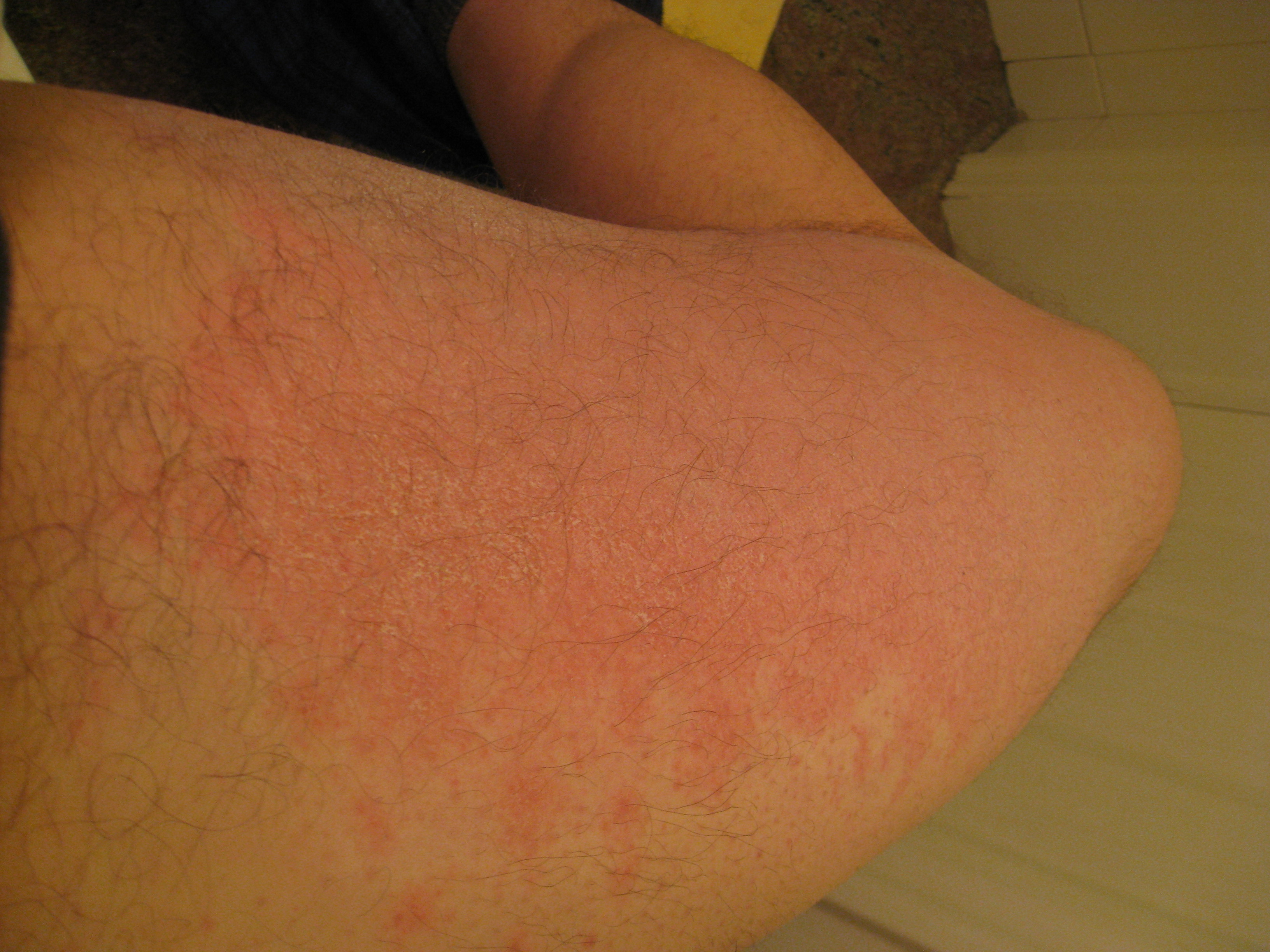 Eczema Rash On Inner Thigh